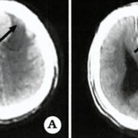 Fig. 1. Caso 1. A. TAC sin contraste. B. TAC con contraste donde se observa una tumoración parasagital frontal con imagen quística.<br />
Se adopta la conducta quirúrgica realizándose exéresis macroscópica total (Simpson II). El estudio anatomopatológico diferido informó: meningioma meningotelial.<br />
