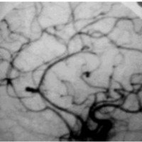 Fig. 2 Aneurisma pericalloso-callosomarginal (sector geniano) angiografía de perfil