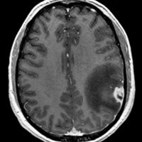 Figura 2: RM pre operatoria cerebro. Secuencia T1 con gadolinio. Corte axial. Lesión nodular intraxial que capta contraste de forma heterogénea con abundante edema perilesional a nivel parietal izquierdo