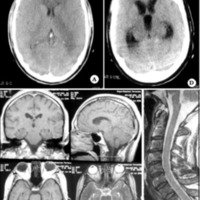 Fig. 2. A. TAC de ingreso. B. IRM de ingreso. C. IRM de columna cervical. D. TAC ulterior.