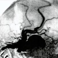 Fig. 14. Fístula con drenaje superior a venas corticales (vista lateral).