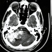 Fig, 1. Tomografía computada cerebral que muestra un tumor de ángulo ponto cerebeloso derecho heterogéneo, con contenido cálcico, que no realza con el contraste endovenoso.