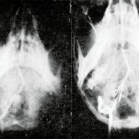 Figura 1. Caso 3. Aneurisma doble, uno hacia dentro que se ve en la arteriografía y otro hacia adelante y afuera que se encuentra en el acto quirúrgico.