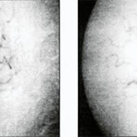 Fig. 7. Angiografía digital. Aneurisma bilobulado, con crecimiento manifiesto en 5 meses.