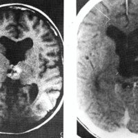Figura 1: TAC que muestra tumor talámico derecho con crecimiento hacia el tercer ventrículo.a) prequirúrgica; b) póstquirúrgica.<br />
