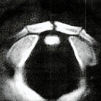 Fig. 1. TAC al ingreso: Se observa fractura del arco anterior del atlas con leve diastasis.