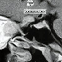 Fig. 2. IRM T1 axial con gadolinio, evidenciando lesiones orbitarias intraconales. Extensión intracraneana de lesión izquierda.