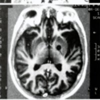 Fig. 3: IRM de control a los 14 días de Palidotomía VPM izquierda, mostrando la correcta ubicaión de la lesión por Radio frecuencia a 83°C a 20º, a nivel del GPi. . A: IRM TI coronal; B: IRM axial; C: IRM sagital