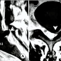Fig. 2. Caso 2. A. IRM de columna lumbar, corte sagital, en la que se evidencia HDL posterolateral izquierda L5-S1. B. IRM de columna lumbar corte axial a nivel L5-S1 en la que se evidencia HDL posterolateral izquierda.