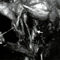Fig. 8. Vista superior del nervio óptico derecho en su porción intraorbitaria (flecha), Se observa la arteria oftálmica cruzándolo por arriba, desde afuera hacia adentro.
