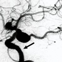 Fig. 4. Angiografía digital de la arteria carótida interna izquierda en proyección lateral. Se observa aneurisma grande de cuello grande.