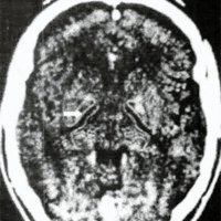 Palidotomía Posteroventral Guiada por Planeamiento Quirúrgico y Micrórregistro como Tratamiento de la Enfermedad de Parkinson Severa.
