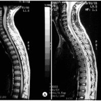 Fig. 5 A. IRM: imagen sagital en T1 que muestra una expansión medular cervical de C2 a C6. B. IRM: imagen sagital en T2 que muestra el aumento de señal dentro de la lesión medular cervical.