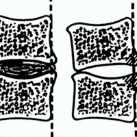 Fig. 4. Esquema que muestra la penetración del osteofito luego de una DSI (modificado de Chesnut RM et al., 1992).