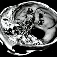 Fig. 3. Reconstrucción tomográfica 3D mostrando amplia reosificación de la craniectomía.