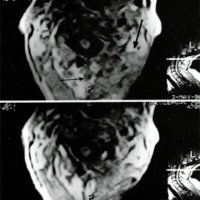 Fig. 5: IRM postoperatoria que muestra la ausencia del tumor y la recuperación del diámetro medular,