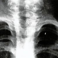 Fig. 2. Rx directa de columna cervical: espina bífida de la 7a vértebra cervical.