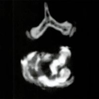 Fig. 8. Paciente AP. Discografia con TC. Voluminosa	fisura del anillo fibroso con salida de contraste al espacio	epidural.