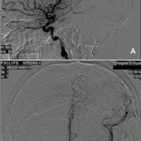 Figura 4: Angiografía digital postoperatoria mediata. A) Incidencia lateral. B) Incidencia anteroposterior.