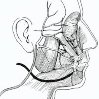 Fig. 4. Anastomosis espinal accesorio-facial. Sección del nervio espinal accesorio (gris claro) y anastomosis con cabo distal nervio facial (blanco) seccionado. El nervio hipogloso no se utiliza.