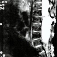 Fig. 12. Caso 6. IRM, corte sagital en T2 en un paciente con MMC. (Se observa el espolón óseo atravesando el canal espinal).