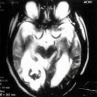Fig. 1. Caso 27, IRM T2. Malformación cavernosa occipital, con edema perilesional
