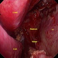 Figura 4: Corredor nasosinusal tras abordaje binostril. Se ha expuesto el rostrum esfenoidal tras haber realizado la septectomía posterior, dejando completamente denudada e intacta a la mucosa septal contralateral (***).