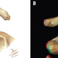 Figura 6: A: Osteotomía grado 5. B: Fotografía 3D de la Osteotomía grado 5.