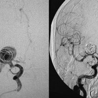 Figura 2: Angiografía de carótida derecha. Aneurisma de la bifurcación de la arteria carótida interna derecha que puso en peligro las dos ramas del tenedor.