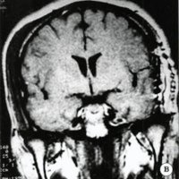Fig. 4. Paciente de sexo masculino y 24 años de edad. IRM: secuencia T1-cortes coronales. A. Preoperatorla. B. Postoperatoria. 