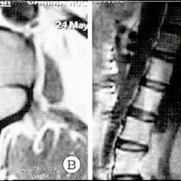 Fig. 3. A y B, IRM preoperatoria. C y D, IRM postoperatoria, mostrando exéresis parcial del tumor.