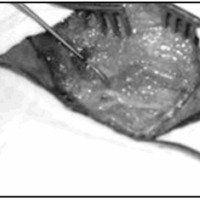 Técnicas microquirúrgicas usadas en la reparación de los nervios periférico (Revisión de la literatura)