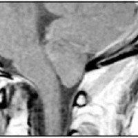 Fig. 1. IRM sagital de cerebro ponderada en T1 que muestra una malformación de Chiari I.