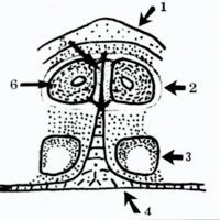 Fig. 2. Mecanismo embriológico de la diplomielia. 1. lámi nas; 2. saco dural único; 3. notocorda; 4. saco vitelino; 5. tabique fibroso intradural; 6. hemimédula.