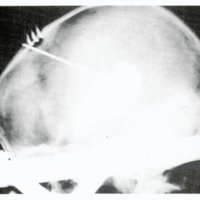 Figura 2b. Rx liitraoperatoria. Llenado del quiste con material radioopaco.