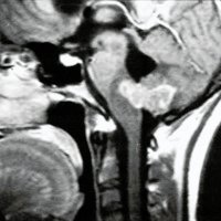 Fig. 1. IRM de cerebro. Imagen hiperintensa en bulbo