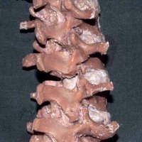 Figura 9: Vista posterolateral derecha. Osteotomía de Grado 2. Resección completa de ambas facetas articulares.