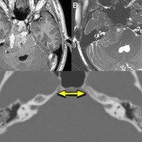 Figura 2: A) Imagen de resonancia magnética T1 con contraste. Se observa lesión expansiva petroclival con captación heterogénea del contraste, que desplaza y comprime<br />
el tronco hacia atrás y medial. B) Imagen de resonancia magnética T2 donde se ve la lesión petroclival que rodea sin invadir al conducto auditivo interno, heterogénea,<br />
sin edema perilesional. C) Ventana ósea de tomografía. La flecha muestra la comparación entre los dos lados, identificando del lado derecho erosión del ápice petroso a<br />
nivel del poro trigeminal.