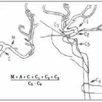 Fig. 1. Procedimiento de Gabrielsen y Greitz37 para medir los vasos cerebrales en la angiografía reproducido por Weir39. La fórmula que figura debajo, fue aplicada por este último autor para ofrecer una relación corregida de la medida usando los vasos.