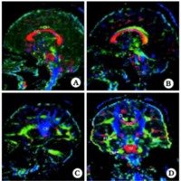 Fisiología cerebral por imágenes: Difusión por tensión - tractografía