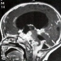 Fig. 2. IRM de cerebro, T1 sin contraste, corte sagital. Se observa gran infiltración leptomeníngea, especialmente a nivel de las cisternas basales y tronco encefálico con compresión del mismo