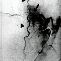 <br />
Fig. 3. Angiografía medular pretratamiento. Fístula dural espinal D8 izquierda, Pie de vena (flecha), Drenaje venoso perimeduiar ascendente y descendente (cabezas de flechas).