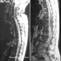 Fig. 3. A. IRM sagitales que muestran AEE anterior cervicotoracolumbar.