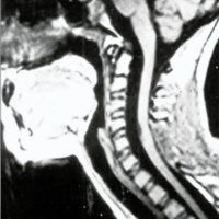 Fig. 5. IRM en T 1 corte sagital postoperatoria que muestra desaparición de la lesión quística y normalización del aspecto medular.
