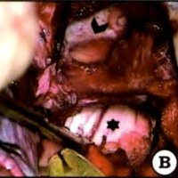 Fig. 5. A. Se visualiza ganglio de Gasser abierto con el contenido tumoral blanco nacarado, friable y avascular. B. Se observa, ya avanzada la resección, cisternas peritroncales (asterisco) ocupadas con tumor. La cabeza de flecha identifica la apertura del ganglio de Gasser sin contenido tumoral. C. Cierre con flap vascularizado de periostio y fascia anterior de músculo temporal que se introduce en las cisternas peritroncales y cavidad del ganglio de Gasser