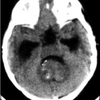 Fig. 2. TAC corte axial: imagen típica de ependimoma de fosa posterior: tumor en IV ventrículo, isodenso, con calcificaciones. Hidrocefalia evolutiva.