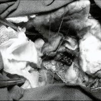 Fig 2. Imagen quirúrgica en el piso del IV ventrículo