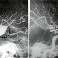 Figura 2. a) Aneurisma gigante con trombo intrasacular. b) Control angiográfico postoperatorio.