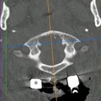 Figura 9: TAC post operatoria donde se observa la odontoidectomía vista en un plano sagital, axial y coronal. Se puede observar, a su vez, el sistema de fijación occípito cervical.