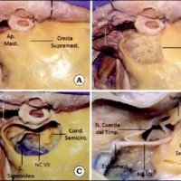 Mini-Mastoidectomía para Anastomosis Hipogloso-Facial con Sección Parcial del Nervio Hipogloso